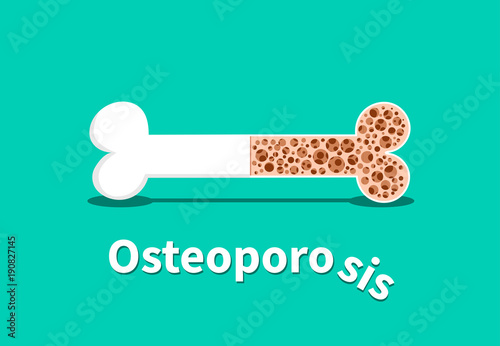 Osteoporosis, Bone structure in vector design