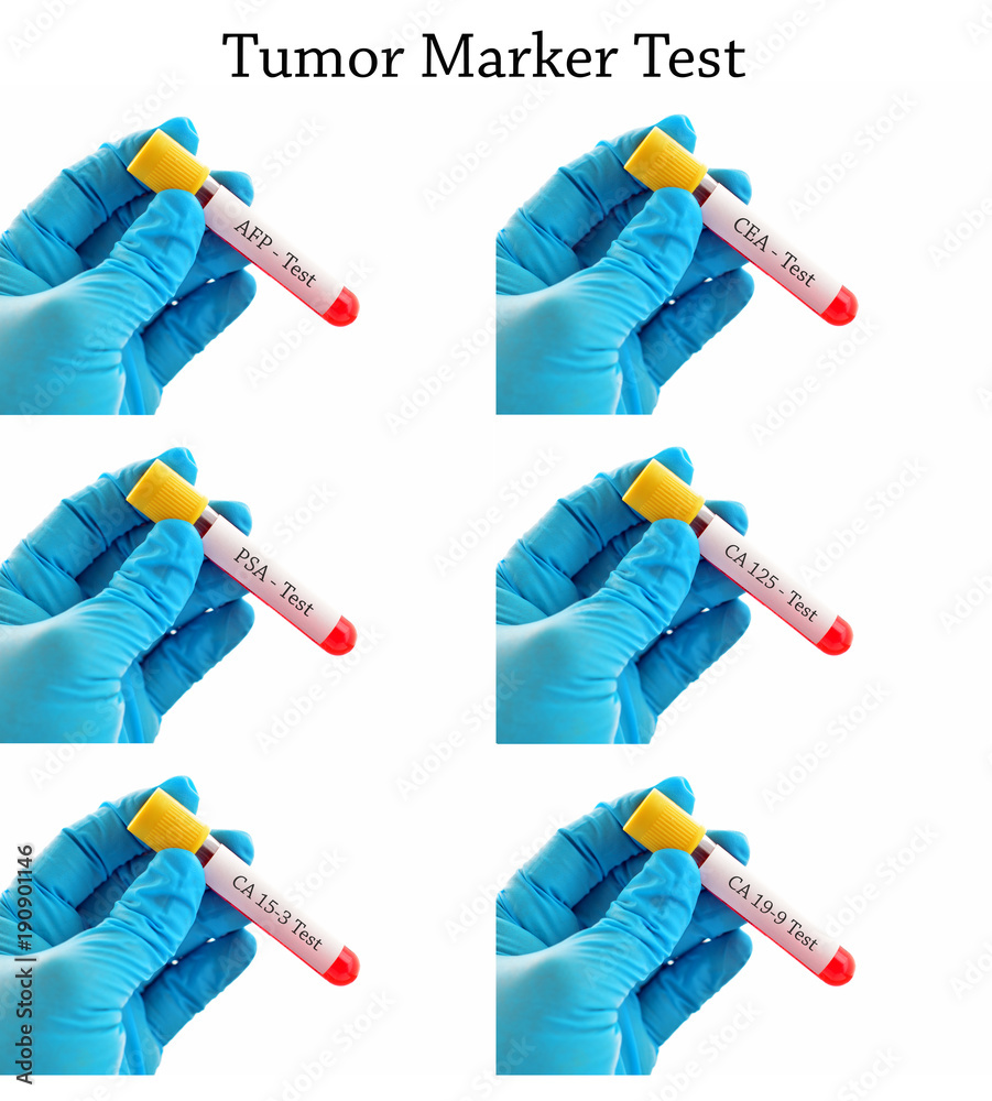 Mixed of blood sample tubes for tumor marker test, AFP, CEA, PSA, CA125,  CA15-3, CA19-9 Stock Photo | Adobe Stock
