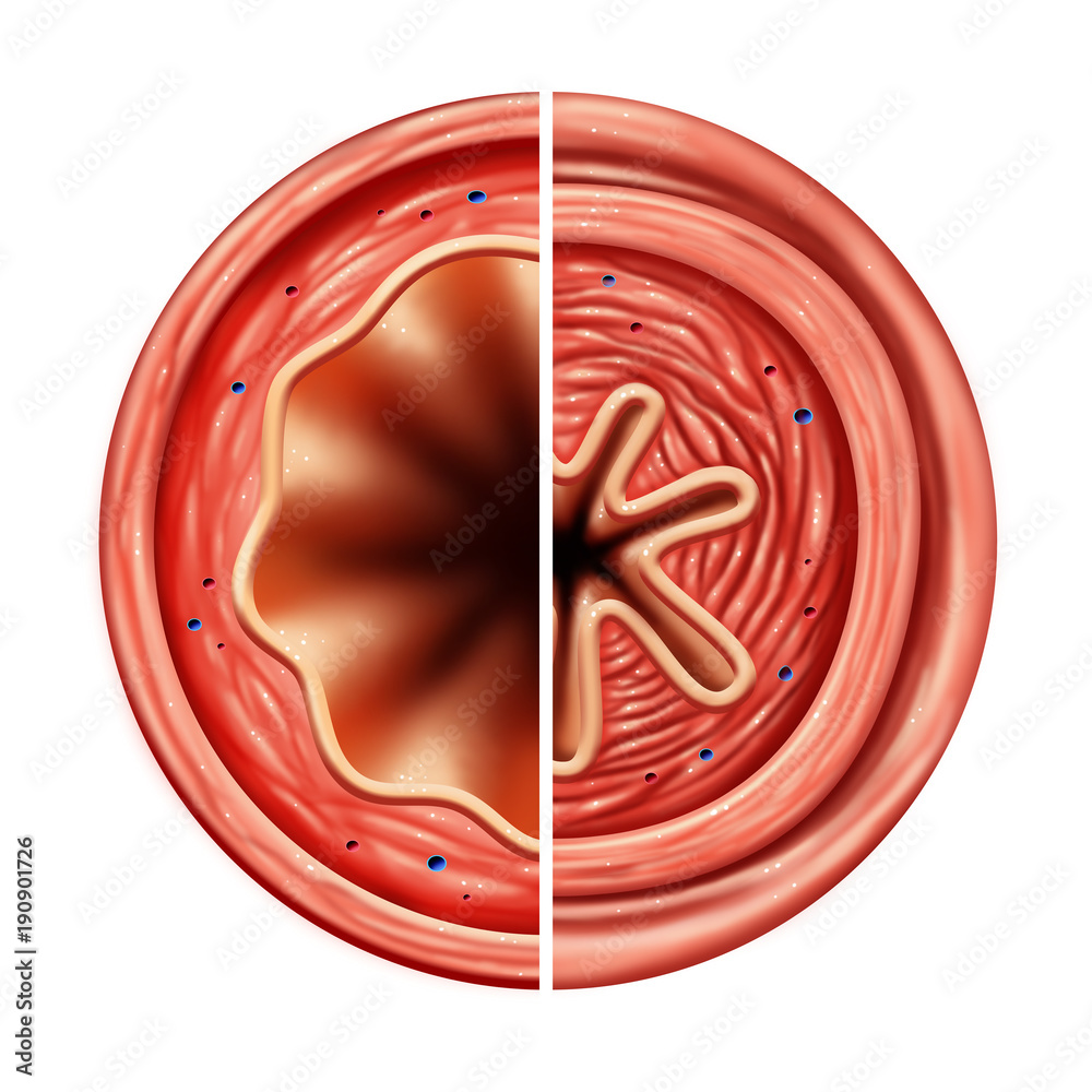 Foto Asthma Bronchial Tube