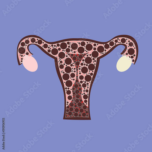 Malignant neoplasm arising from cells in the cervix uteri.