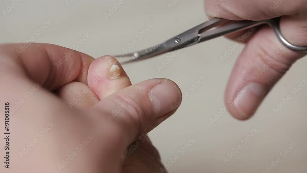 Man cutting toenails with scissors. Male cut toenails on foot. Toenails