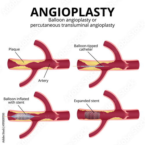balloon angioplasty photo