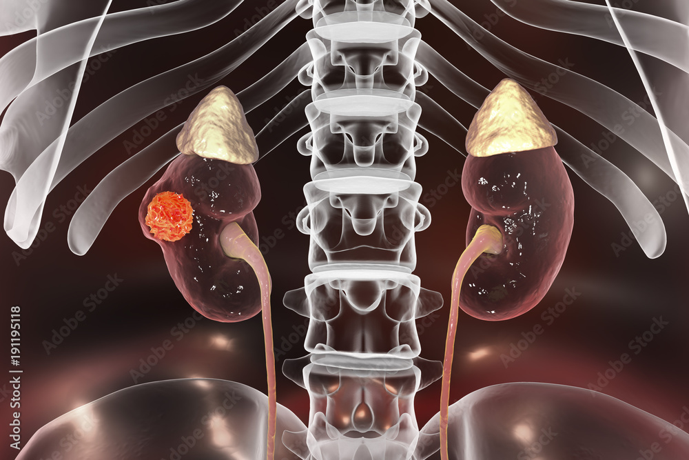 Cancer of kidney, 3D illustration showing presence of cancerous tumor inside kidney tissue Stock