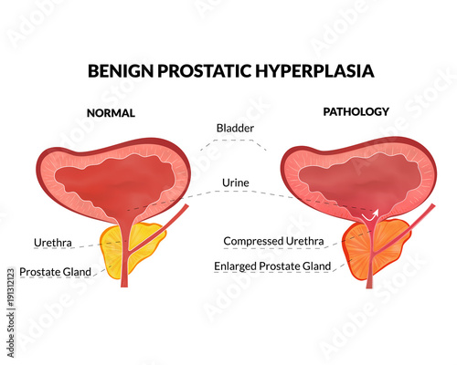 Benign prostatic hyperplasia is an non lethal pathology with timely treatment photo