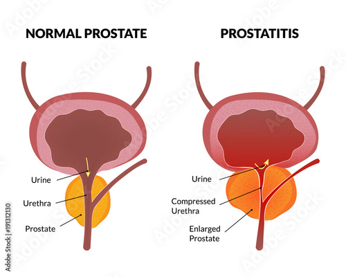 Prostatitis can cause cancer tumors without urgent treatment photo