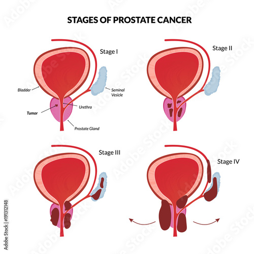 Four stages of prostate malignant tumor spreading.
