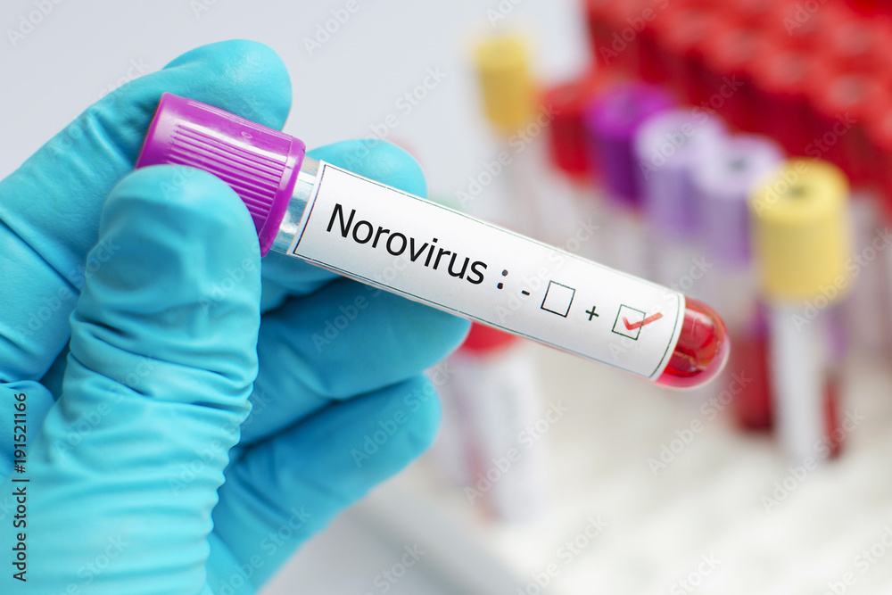 Blood sample positive with Norovirus
