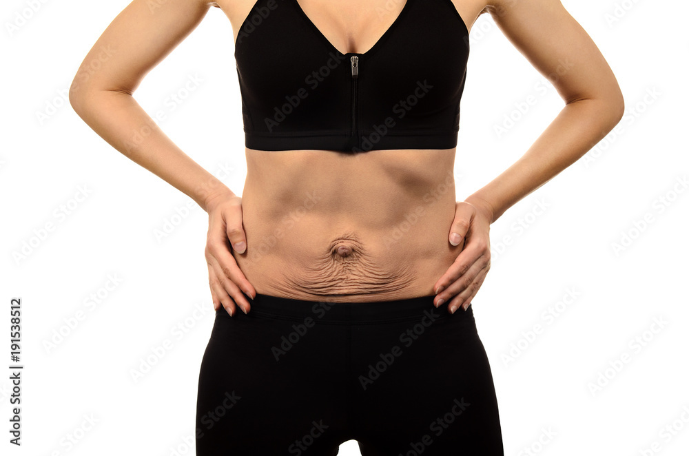 Diastasis recti. Woman's abdomen divergence of the muscles of the abdomen after pregnancy and childbirth. Loose skin on belly.
