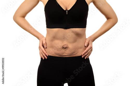 Obraz na płótnie Diastasis recti. Woman's abdomen divergence of the muscles of the abdomen after pregnancy and childbirth. Loose skin on belly. w salonie