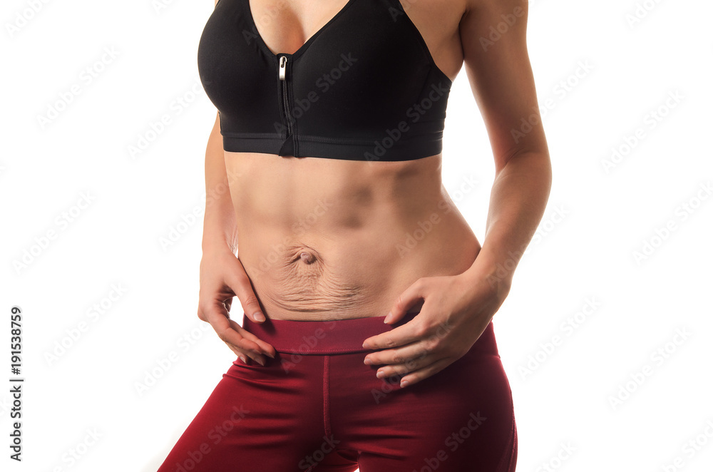 Diastasis recti. Woman's abdomen divergence of the muscles of the abdomen after pregnancy and childbirth.