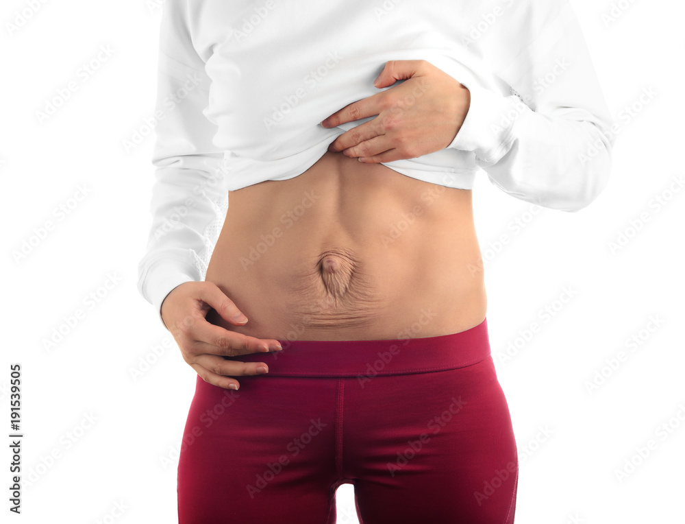 Diastasis recti. Woman's abdomen divergence of the muscles of the abdomen after pregnancy and childbirth.
