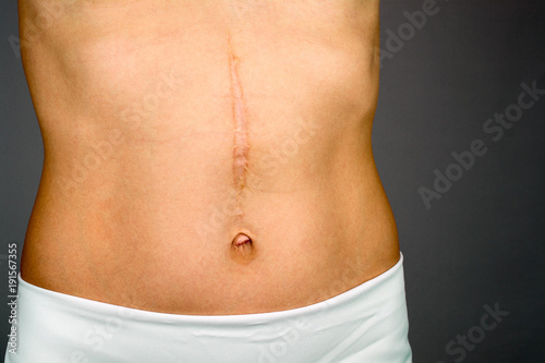 scars removal concept, large scar after surgery on the abdomen young woman, blurred neutral background, selective focus