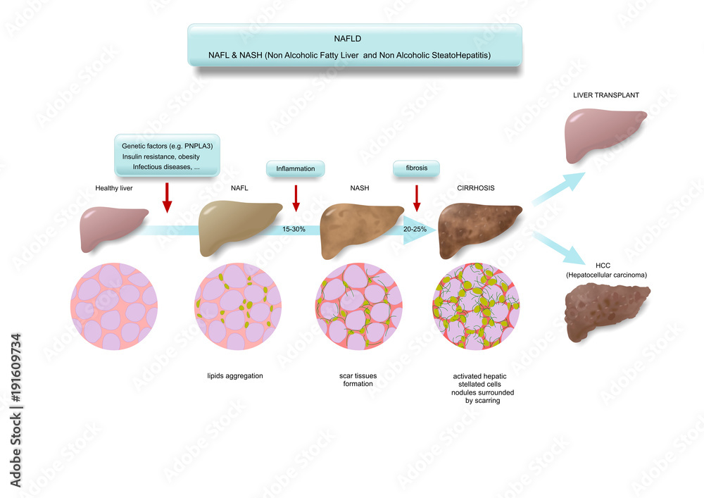 Various stages of fatty liver disease (NAFLD) Stock Illustration ...