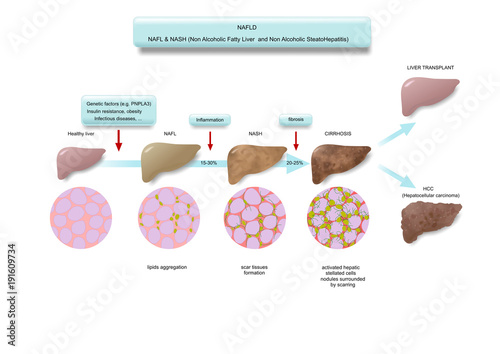Various stages of fatty liver disease (NAFLD) photo