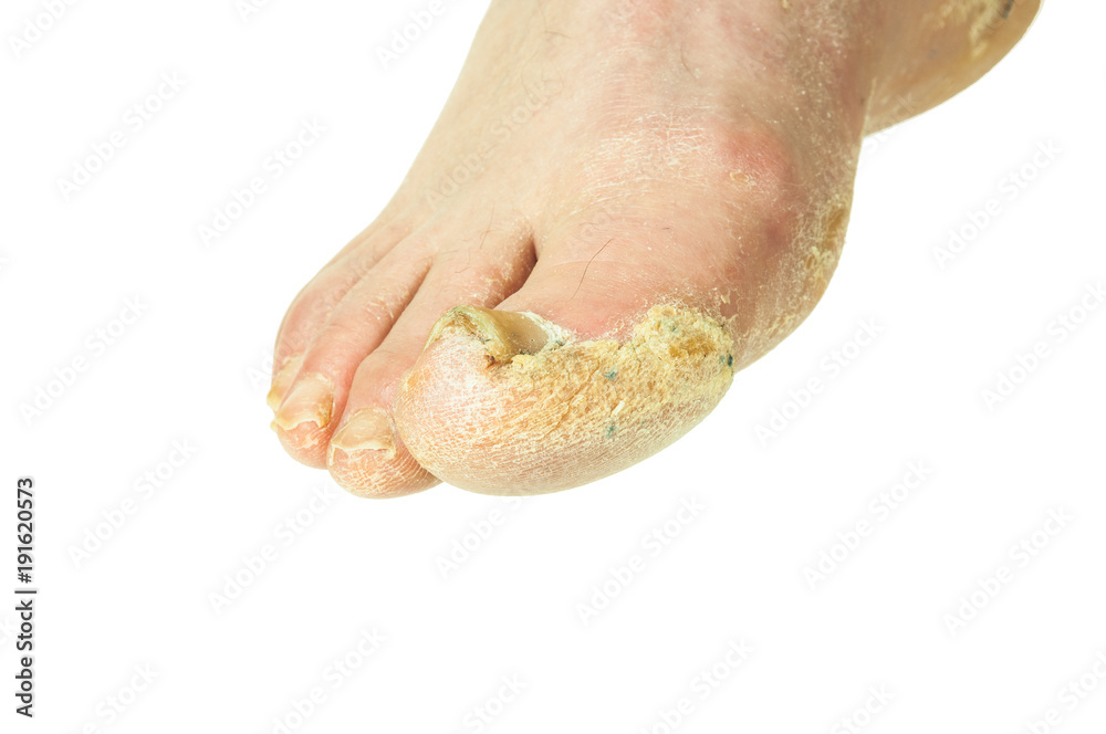 Toenail damage close up. Feet of an old man with toenail trauma and bacterial  infection Stock Photo - Alamy