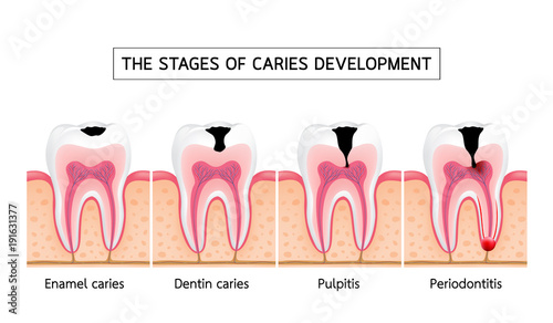 Stages of caries development. Enamel caries, Dentin caries, Pulpitis and Periodontitis. Dental care info-graphic, illustration on white background.