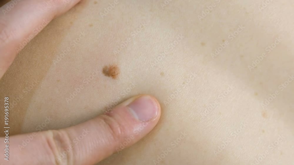 Man's hand touches the mole on the woman's skin. Doctor medical screening. Close up hand and mole. Man's hand touches the mole on the woman's skin. Doctor medical screening. Close up hand and mole.