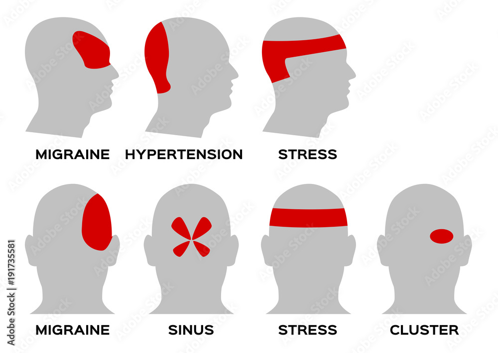 Headache type vector organ and anatomy concept stock vector adobe stock