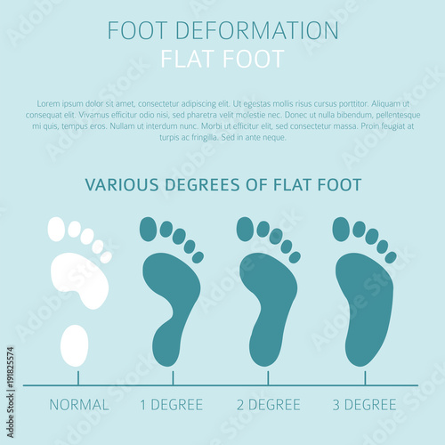 Foot deformation as medical desease infographic. Causes of Flat foot