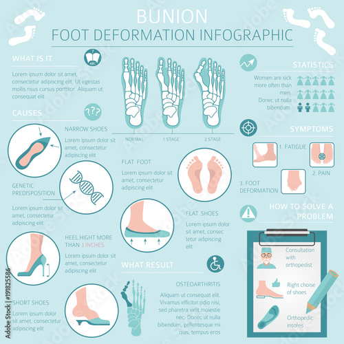 Foot deformation as medical desease infographic. Causes of bunion