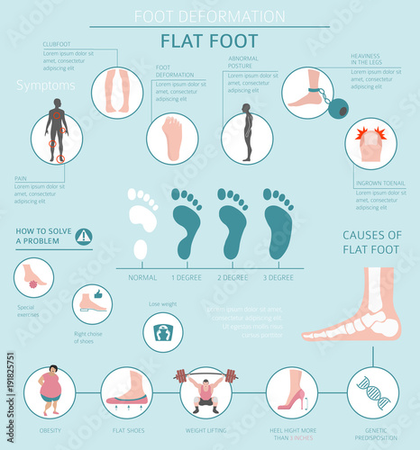 Foot deformation as medical desease infographic. Causes of Flat foot