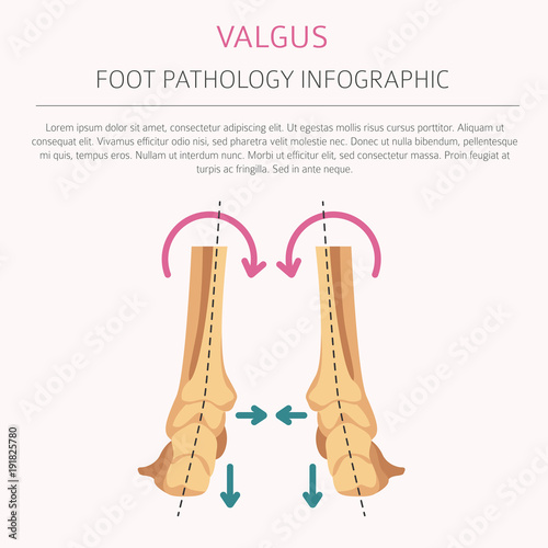 Foot deformation as medical desease infographic. Valgus and varus defect