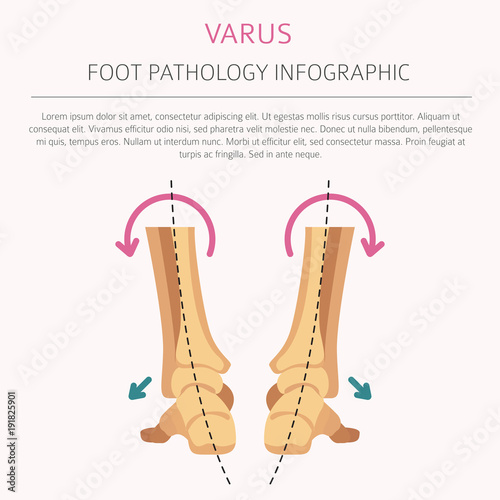 Foot deformation as medical desease infographic. Valgus and varus defect