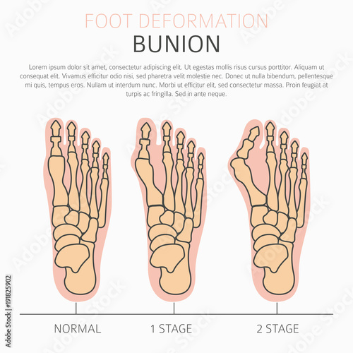 Foot deformation as medical desease infographic. Causes of bunion