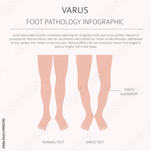 Foot deformation as medical desease infographic. Valgus and varus defect