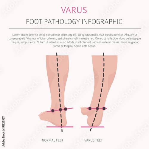 Foot deformation as medical desease infographic. Valgus and varus defect