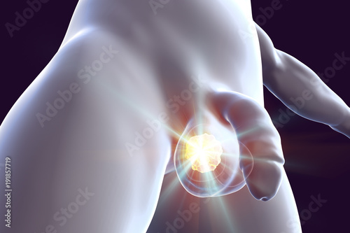 Testicular cancer treatment concept. Cancer of testis, 3D illustration