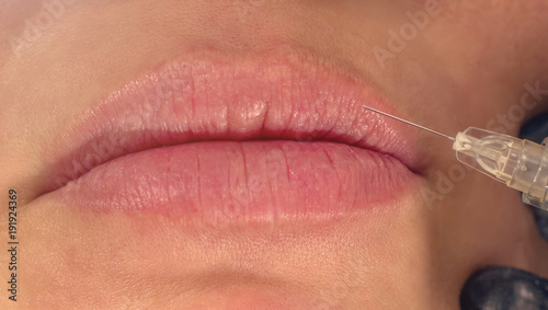 Beauty injections Close Up. Lip filler injection. photo