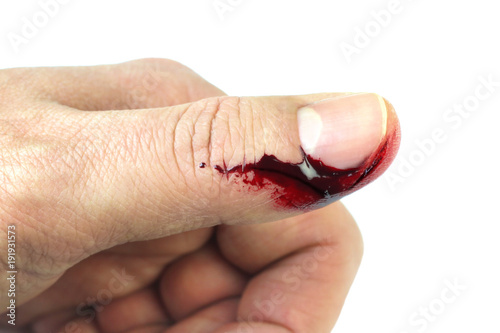Finger on left thumb human hand is cut hurt and bleeding 