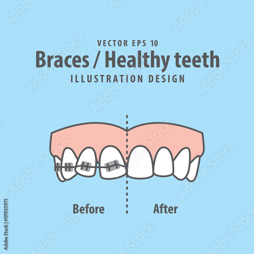 Braces-Healthy teeth illustration vector on blue background. Dental concept.