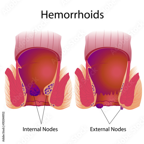 Hemorrhoids external and internal nodes