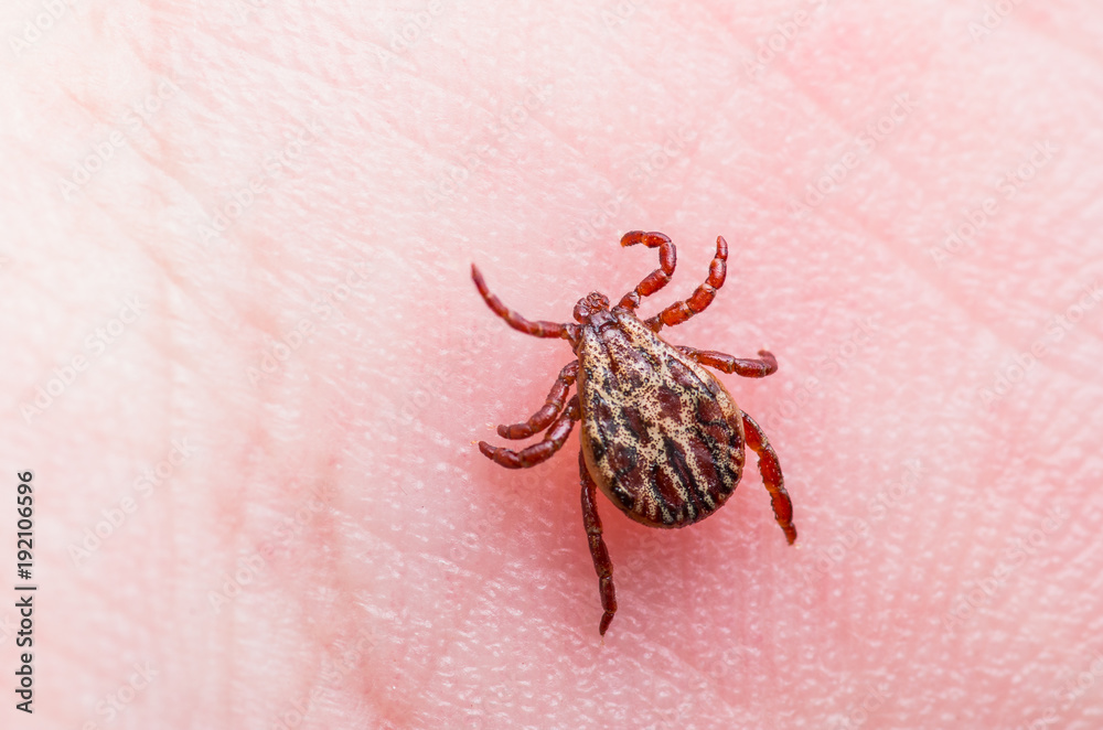 Encephalitis or Lyme Virus Infected Tick Arachnid Insect on Skin Encephalitis or Lyme Virus Infected Tick Arachnid Insect on Skin
