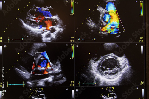 Heart ultrasound image on a computer screen.