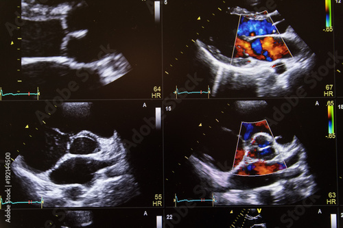 Heart ultrasound image on a computer screen. photo