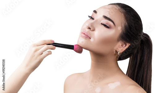 Tableau sur toile Portrait of beautiful woman with vitiligo disease.