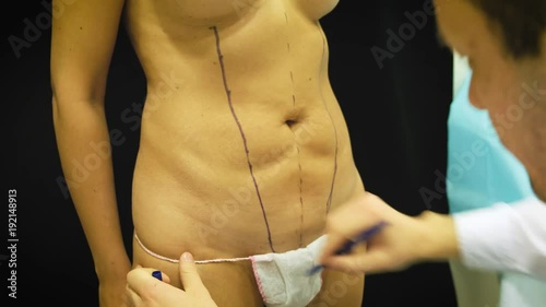 thick elderly woman prepares to medical liposuction. Doctor draws marker, mark on the abdomen. The surgeon draws the markup before the operation by liposuction on the patient to the woman. photo