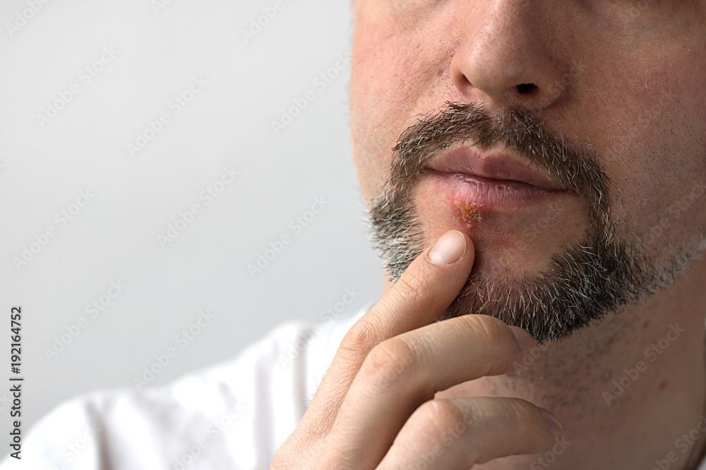 Fototapeta premium Medicine Illness Herpes Man Beard Healthy