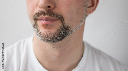 Medicine Illness Herpes Man Beard Healthy