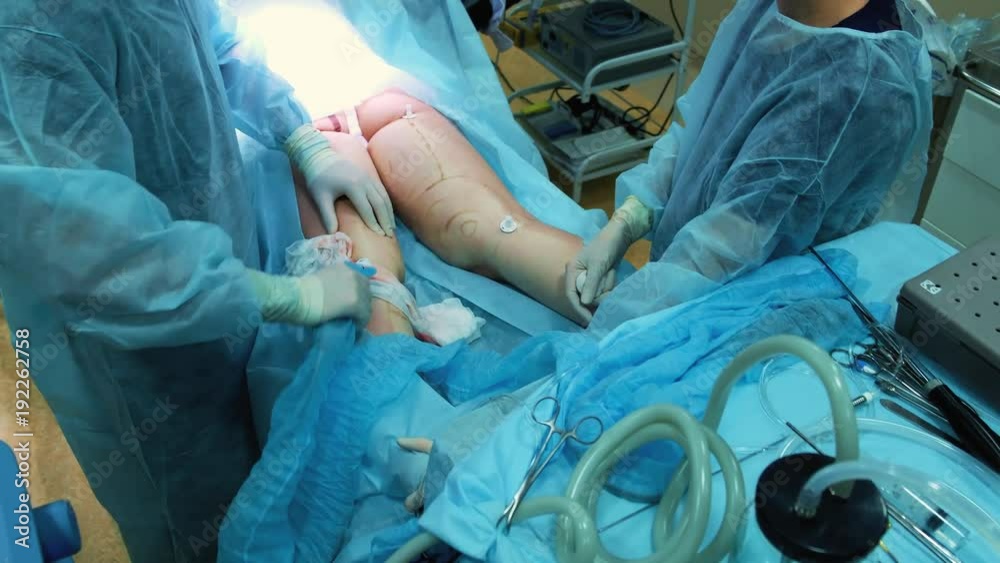 Operating room: preparations for liposuction surgery. a team of surgeons do the operation of liposuction to a girl. The surgeon works as a cannula Operating room: preparations for liposuction surgery. a team of surgeons do the operation of liposuction to a girl. The surgeon works as a cannula