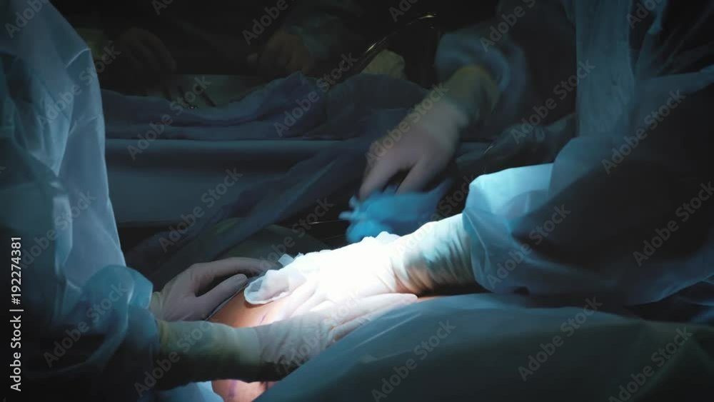 Surgeon and surgical team are performing cosmetic surgery on breasts in hospital operating room. Breast augmentation. Breast enlargement. Liposuction. Emergency care. Surgery detail Surgeon and surgical team are performing cosmetic surgery on breasts in hospital operating room. Breast augmentation. Breast enlargement. Liposuction. Emergency care. Surgery detail