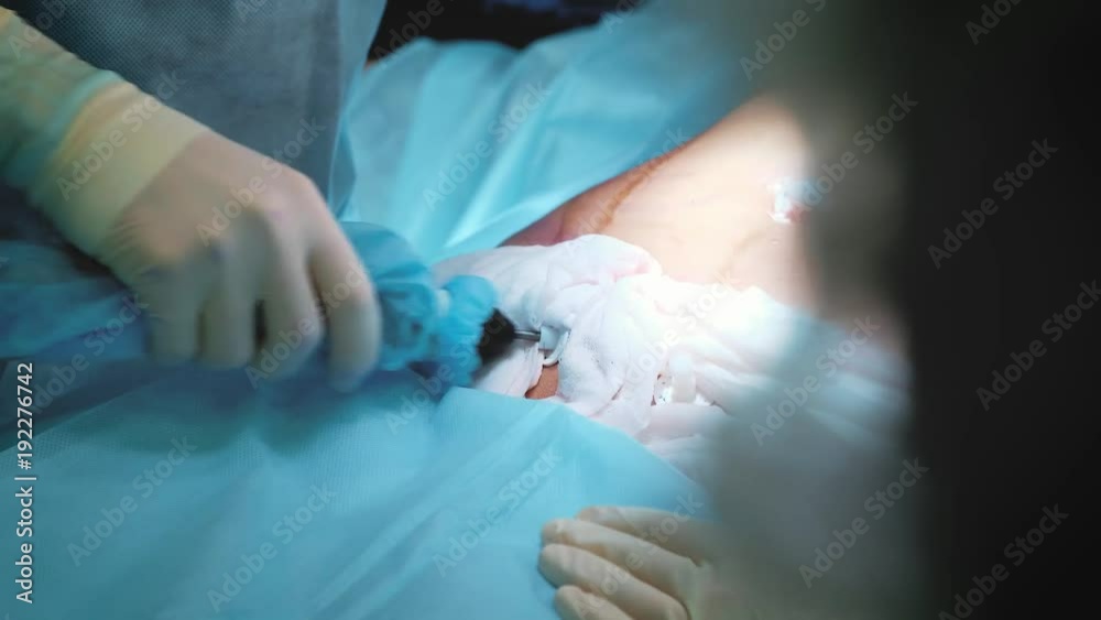 Surgeon and surgical team are performing cosmetic surgery on breasts in hospital operating room. Breast augmentation. Breast enlargement. Liposuction. Emergency care. Surgery detail Surgeon and surgical team are performing cosmetic surgery on breasts in hospital operating room. Breast augmentation. Breast enlargement. Liposuction. Emergency care. Surgery detail
