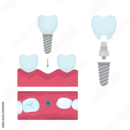 Dental crowns and implantation