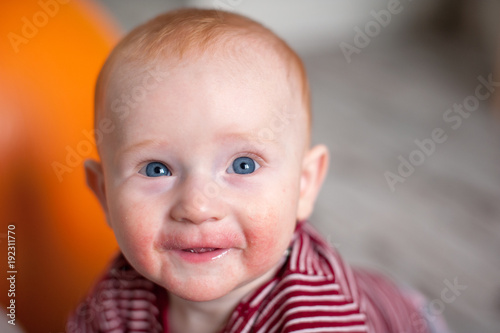 Infant in manifestations of allergy on the face