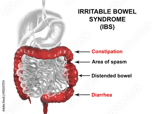 Irritable bowel syndrome IBS medical concept, 3D illustration showing spasms and distortion of large intestine