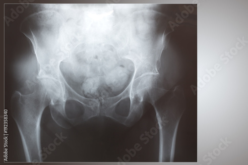 X-ray of beginning osteonecrosis of the femoral head photo