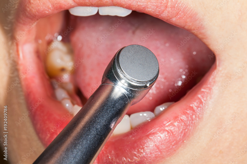 Fototapeta premium Dental treatment close up